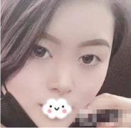 徐州亞韓整形醫(yī)院做雙眼皮怎么樣？雙眼皮整形日記一覽
