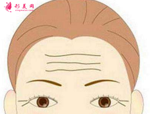 如何去除抬頭紋
