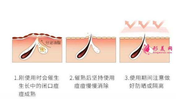 果酸換膚是什么