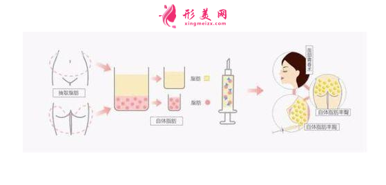 自體脂肪填充淚溝