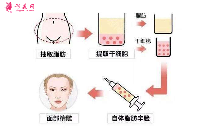 自體脂肪填充淚溝