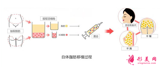 自身脂肪隆胸手術(shù)比假體好嗎