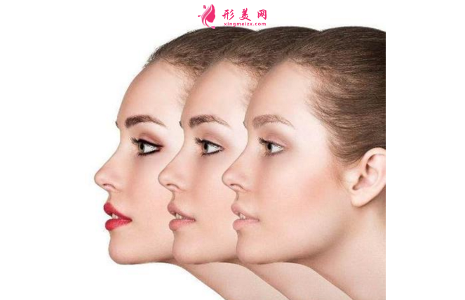 自體脂肪豐下巴會(huì)全部吸收了嗎?