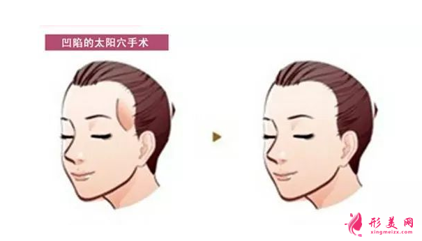 自體脂肪豐下巴會(huì)全部吸收了嗎?