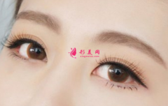 怎么避免雙眼皮手術(shù)的風險？
