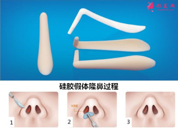假體隆鼻用什么材料比較好