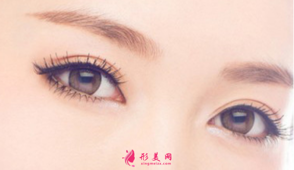 雙眼皮手術(shù)是局麻還是全麻