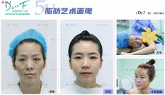 馮斌做吸脂手術(shù)需要多少費用？