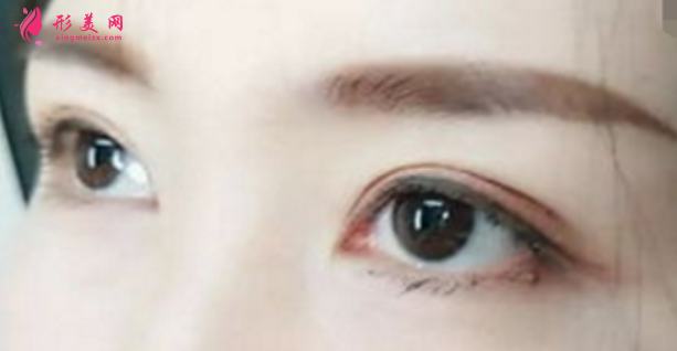 做雙眼皮手術(shù)到底好不好