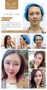 馮斌解答：自體脂肪與玻尿酸有什么區(qū)別？