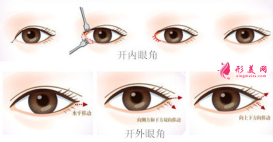 開內(nèi)眼角和開外眼角的區(qū)別