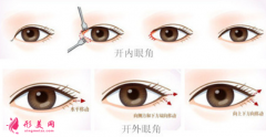 開內(nèi)眼角和開外眼角的區(qū)別?