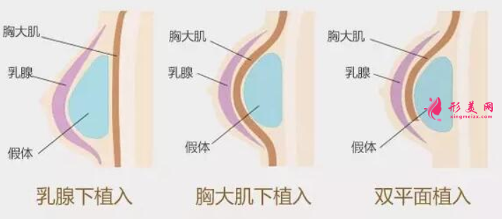 假體隆胸后可以喂母乳么