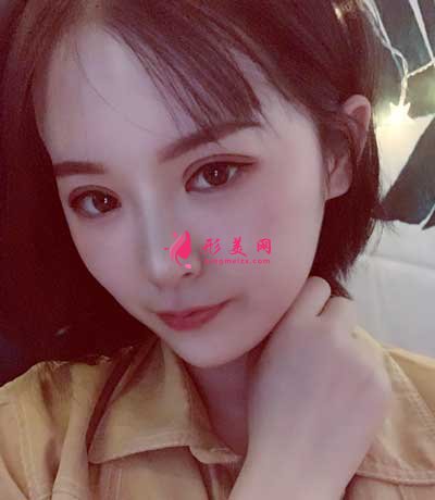 去佛山華美找梁宗建院長做全切雙眼皮手術(shù)后2個月