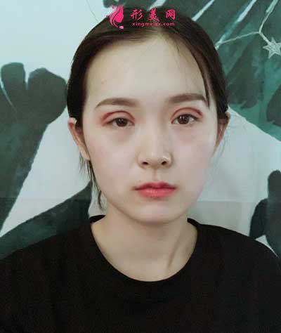 去佛山華美找梁宗建院長做全切雙眼皮手術(shù)后第5天