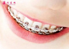 成都華西矯正牙齒需要多少錢?為什么價(jià)格有高有低？