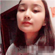長沙愛思特胡朝輝磨骨手術(shù)做的怎么樣？附磨骨前后對比圖