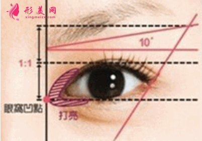 開內(nèi)眼角疤痕增生能消下去嗎