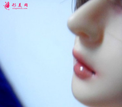 假體隆鼻后多久可以取出
