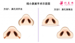 鼻翼縮小術(shù)后痛不痛？
