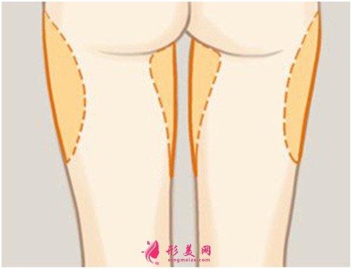 韓國大腿吸脂示意圖