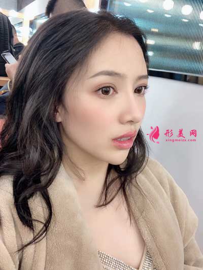 消失空白的寬鼻矯正術(shù)后120天照
