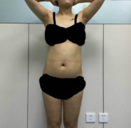 上海九院吸脂怎么樣？全身吸脂案例分享，術后前后對比圖