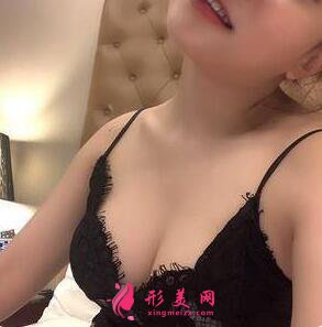 自體脂肪隆胸術(shù)后第35天