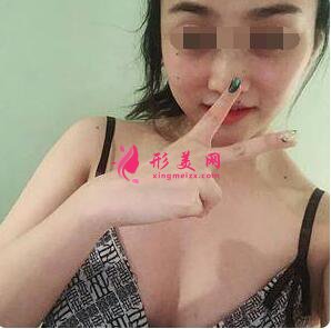 自體脂肪隆胸術(shù)后第18天
