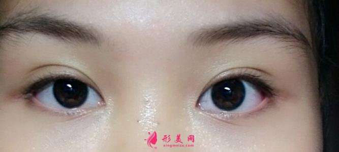 專(zhuān)業(yè)雙眼皮手術(shù)后腫脹大概在幾天