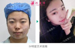 馮斌：面部脂肪填充價(jià)格貴不貴？