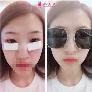 2020！深圳名媛匯整形醫(yī)療美容價格表，外切去眼袋體驗分享