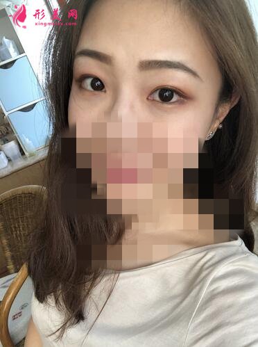 2020！深圳名媛匯整形醫(yī)療美容價格表，外切去眼袋體驗(yàn)分享