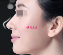 整形醫(yī)院軟骨隆鼻費(fèi)用貴嗎？