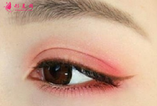 埋線雙眼皮手術(shù)的優(yōu)點(diǎn)有哪些