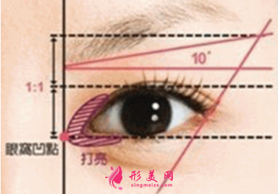 開眼角術(shù)后腫脹多久消退