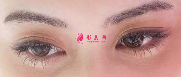 切開雙眼皮術(shù)后需要注意的事項