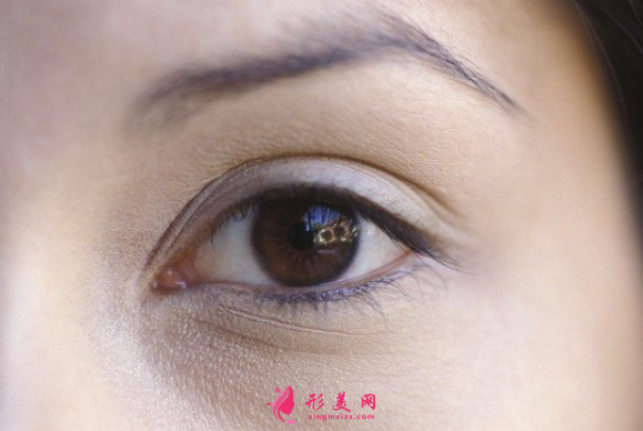 開眼角術(shù)后要怎樣恢復(fù)得更好