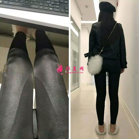 深圳顏美醫(yī)療美容醫(yī)院吸脂案例，打造纖細(xì)大腿