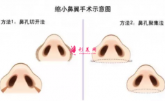 鼻翼縮小手術(shù)后可以化妝嗎？