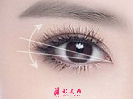 開(kāi)眼角后怎么避免疤痕增生