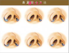 鼻翼縮小手術(shù)后會(huì)有腫脹嗎？