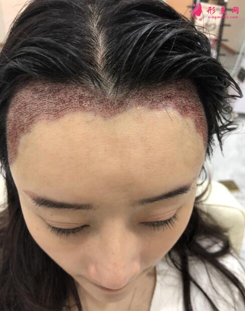 女性毛發(fā)種植術(shù)后98天效果反饋，很驚人就對了！