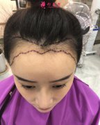 女性毛發(fā)種植術(shù)后98天效果反饋，很驚人就對了！