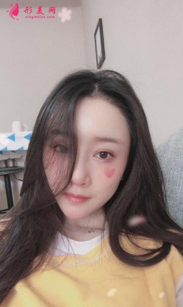 女性毛發(fā)種植術(shù)后98天效果反饋，很驚人就對了！
