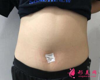 360吸脂案例對(duì)比，成功瘦身成為大美女啦！