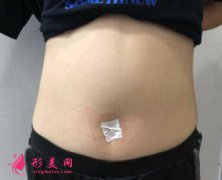 360吸脂案例前后對比，成功瘦身成為大美女啦！