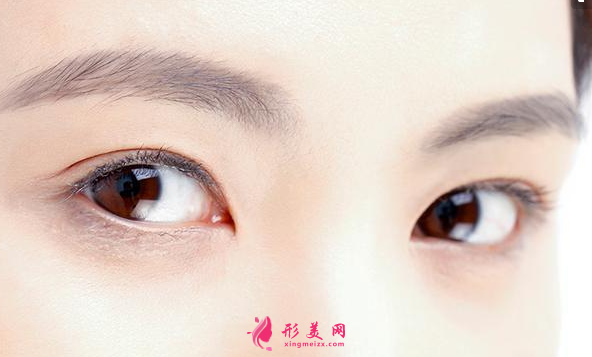 雙眼皮手術(shù)拆線后要涂祛疤膏嗎