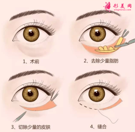 手術(shù)祛眼袋的過程痛不痛
