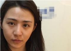 上海長海醫(yī)院整形科隆鼻價格表（費用），案例展示